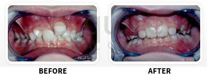 Orthodontics Before After Image 01
