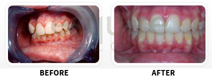 Orthodontics Before After Image 06