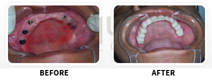 Dental Implants Before After image 05