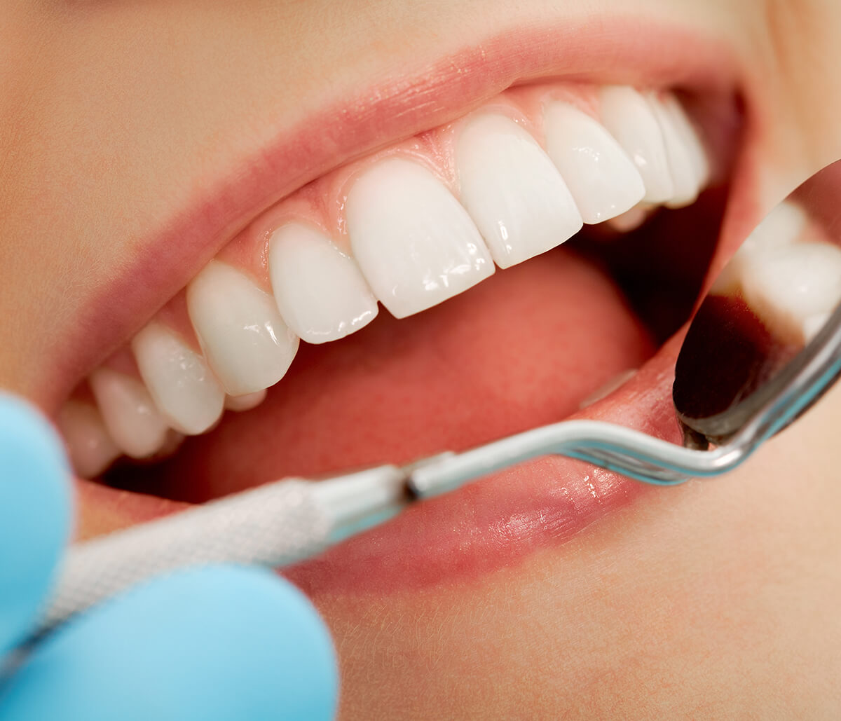 The Expert Dentist Offering Teeth Whitening Services in Scarborough, ON Area