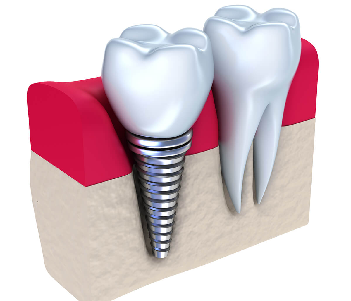 Dental Implant Procedure in Scarborough Area