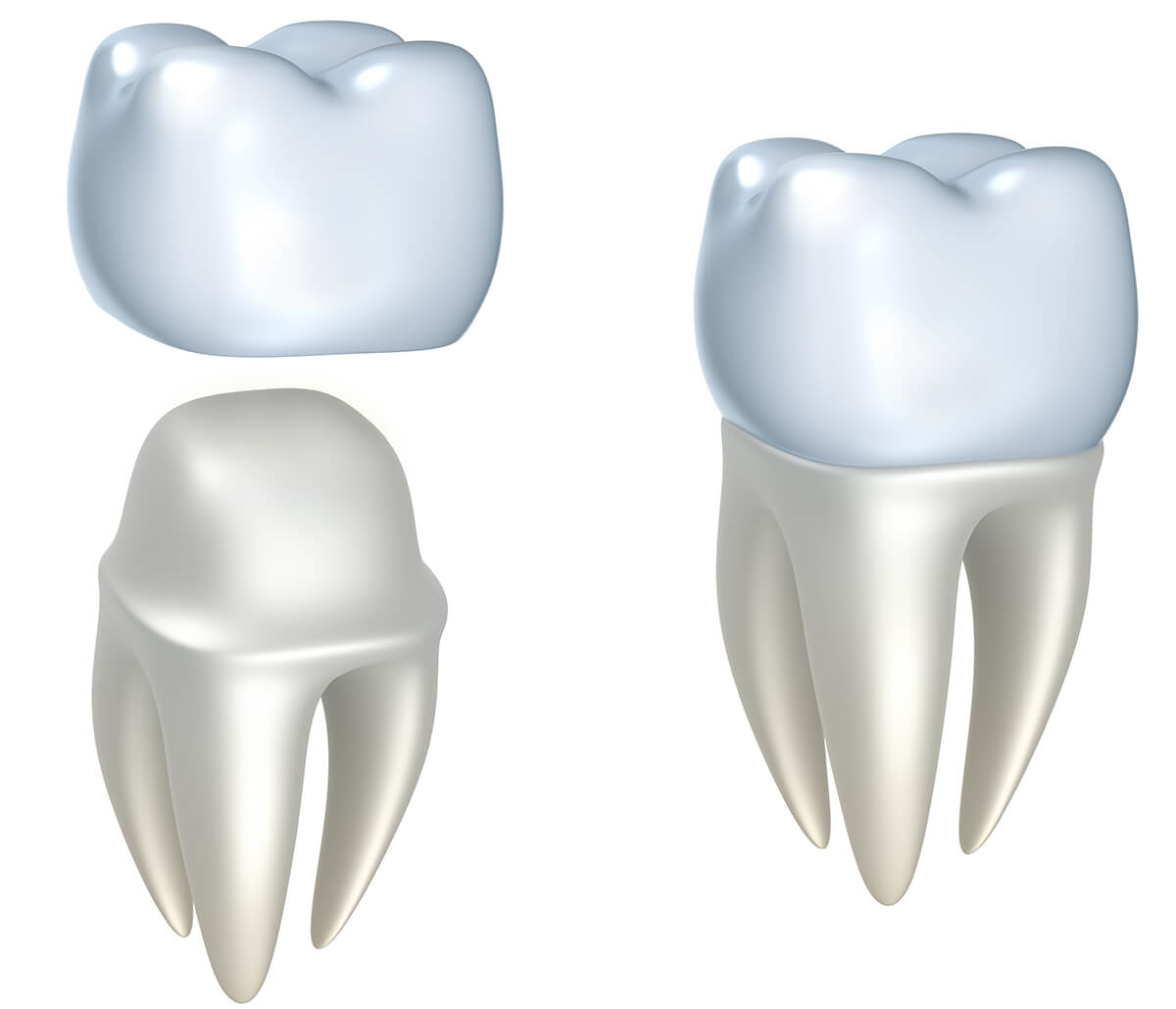 Cosmetic Dental Crowns in North York ON Area