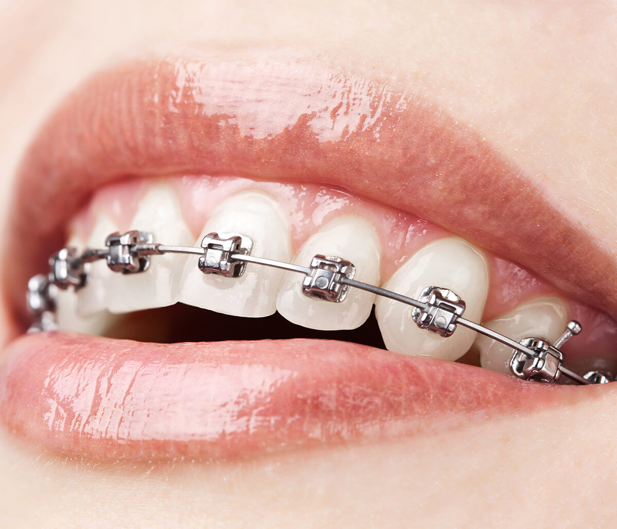 Affordable Braces for Adults in Scarborough ON Area