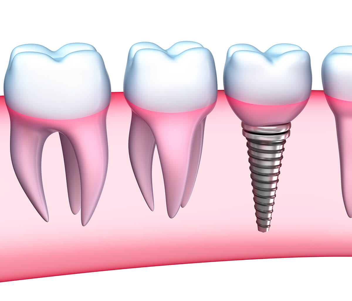How Painful is Dental Implant Procedure in Scarborough ON Area