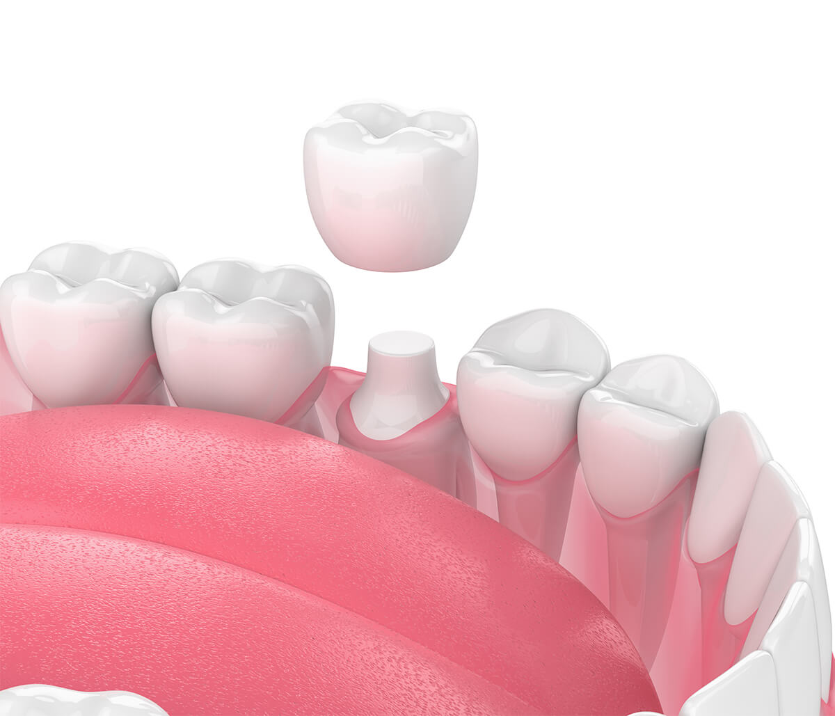 Cosmetic Dental Crowns in Scarborough ON Area