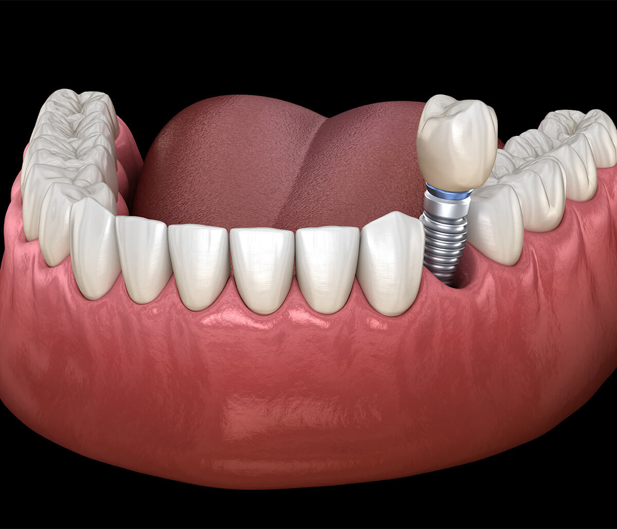 Tooth Implants Dentist Near Me Scarborough ON Area