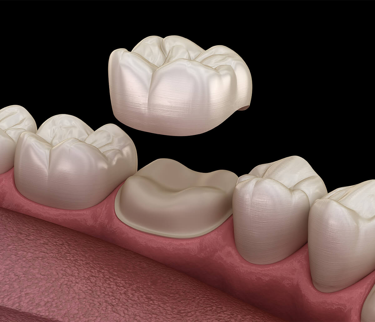 Dental Crowns on Front Teeth in Pickering ON Area